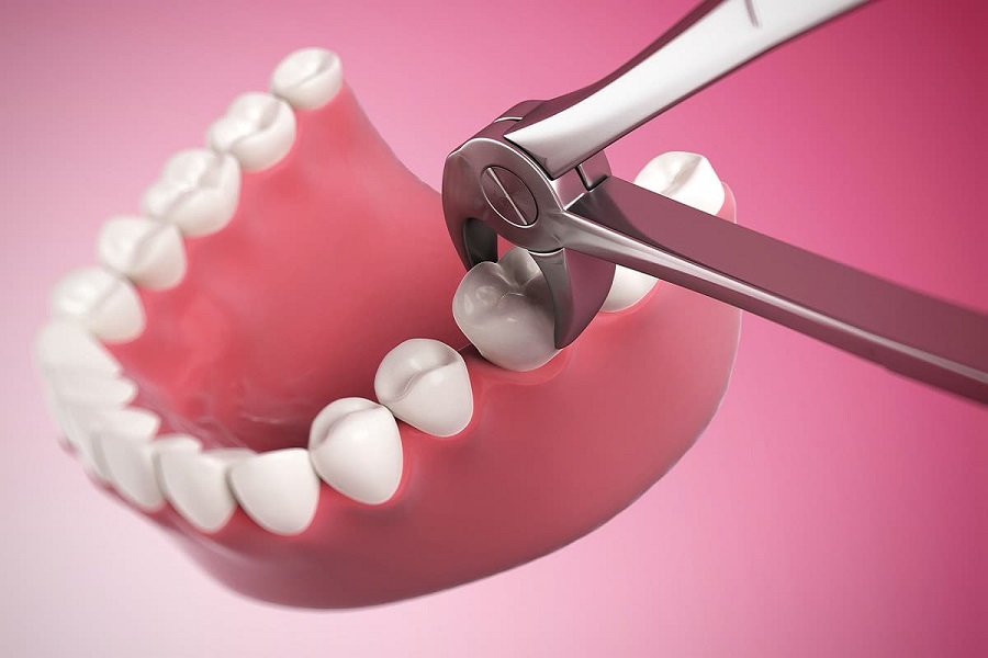 Как проводится удаление зуба