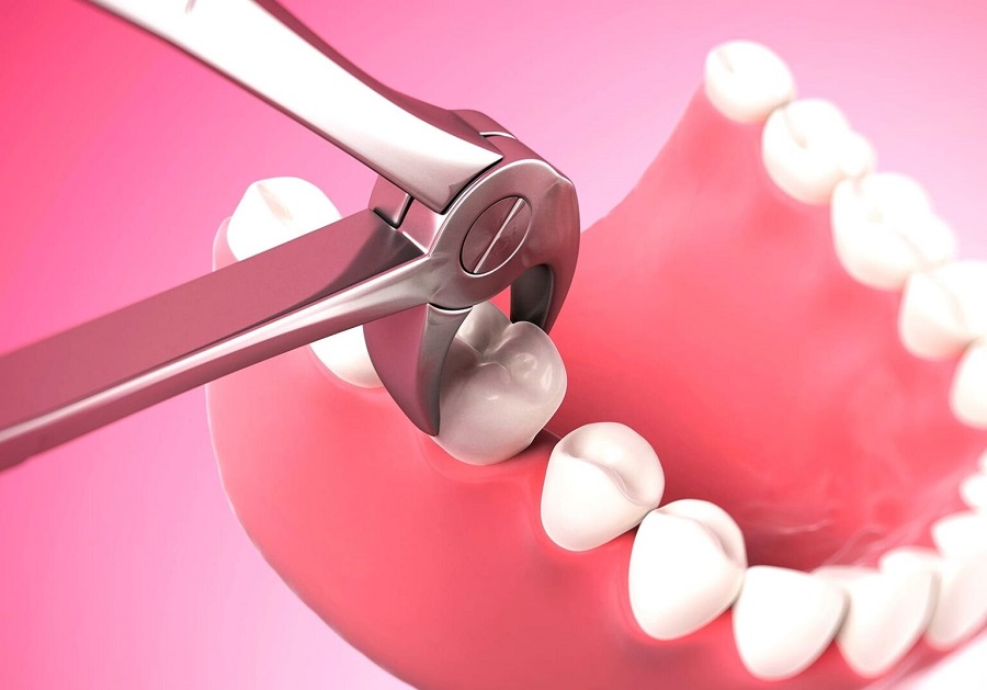 Как происходит процедура удаления зуба